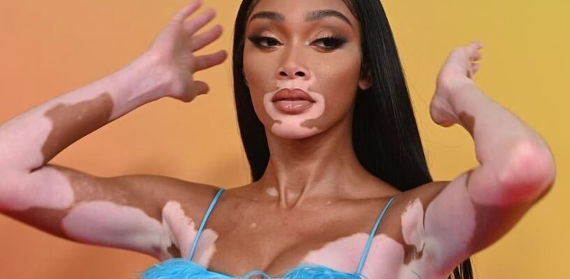 Що таке вітіліго: коли шкіра стає полотном без фарб