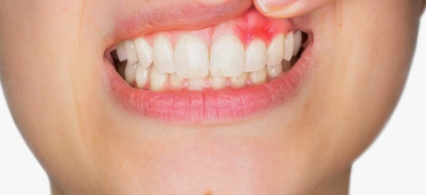 Що таке гранульома і чому її не можна ігнорувати