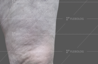 Чи безпечно повернутись до роботи після операції на сонній артерії?