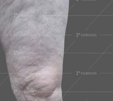 Чи безпечно повернутись до роботи після операції на сонній артерії?