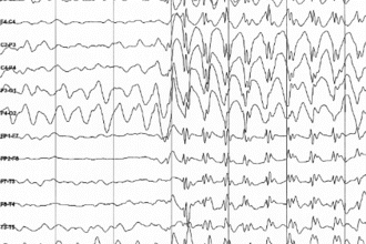 Чи є епілепсія спадковим захворюванням: основні факти та міфи