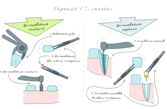Чи можливо встановити коронку на живий зуб без видалення нерва?