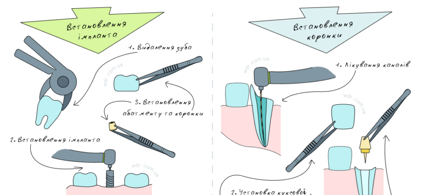 Чи можливо встановити коронку на живий зуб без видалення нерва?