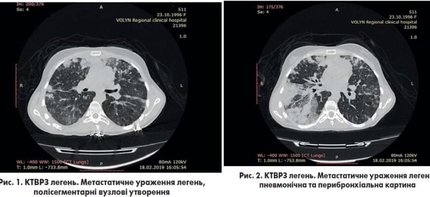 Чи можна ефективно лікувати метастази: сучасні підходи та перспективи