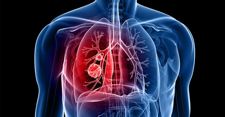 Чи можна повністю вилікувати ХОЗЛ: сучасні методи та рекомендації