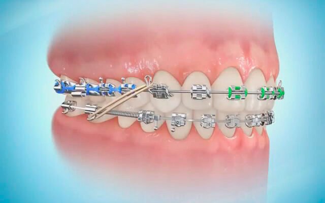 Чи можна встановити брекети на зубні коронки: важливі поради та нюанси