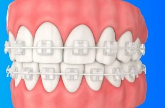 Чи можна встановити брекети тільки на одну щелепу: важливі нюанси