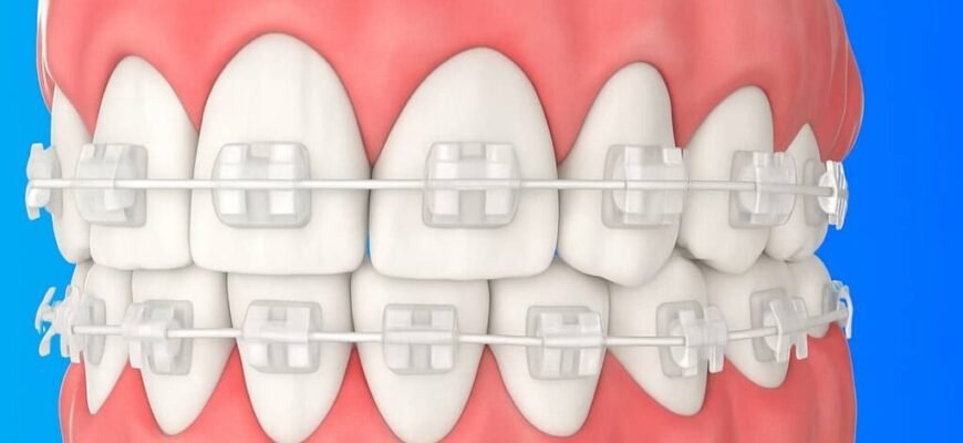 Чи можна встановити брекети тільки на одну щелепу: важливі нюанси Чи можна встановити брекети тільки на одну щелепу: важливі нюанси