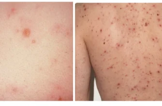 Чи можна виходити на вулицю з вітрянкою: поради та рекомендації лікарів