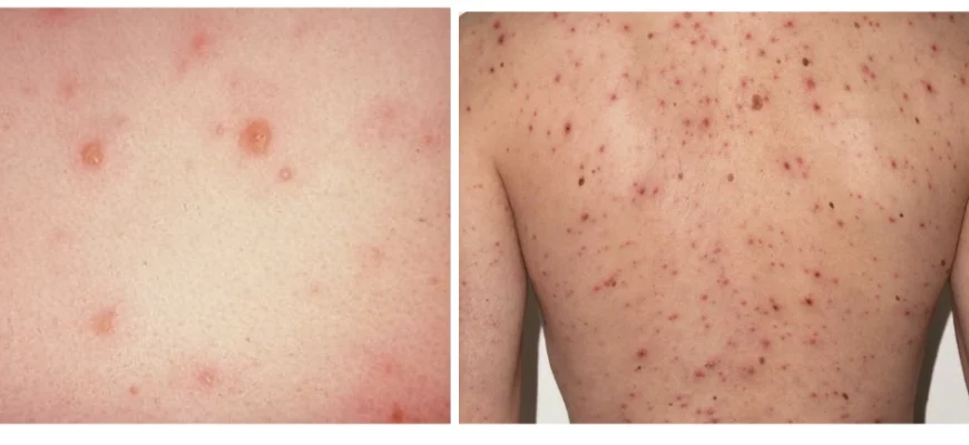 Чи можна виходити на вулицю з вітрянкою: поради та рекомендації лікарів