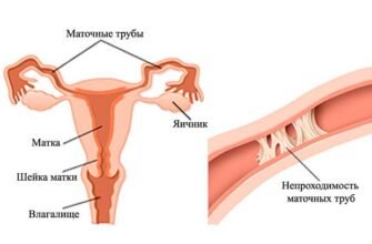 Чи можуть утворюватися спайки після лапароскопії: розбір ризиків