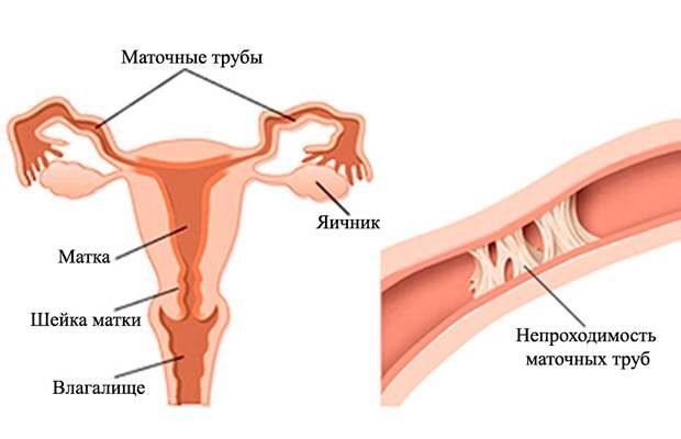 Чи можуть утворюватися спайки після лапароскопії: розбір ризиків