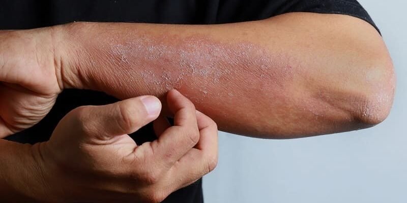 Чи передається екзема: міфи та реальність, способи захисту шкіри Чи передається екзема: міфи та реальність, способи захисту шкіри