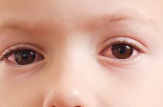 Чи передається кон’юнктивіт? Відкрийте правду про зараження!