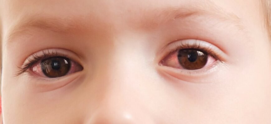 Чи передається кон’юнктивіт? Відкрийте правду про зараження!