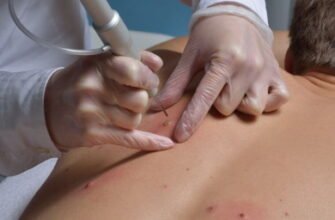 Чи потрібно видаляти жировик: рекомендації та поради лікарів