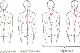 Чи реально вилікувати сколіоз 3 ступеня: сучасні методи лікування