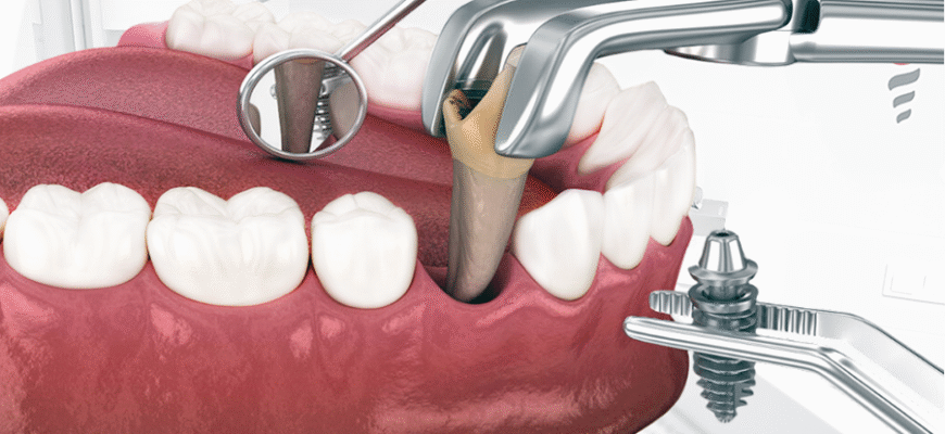 Чи варто ставити зубні імпланти: переваги, ризики та рекомендації