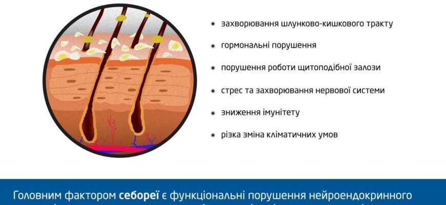 Чи заразний себорейний дерматит: правда про передачу захворювання