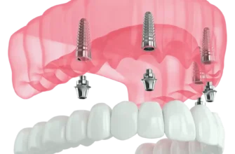 Імплант чи імплантат: як правильно обрати стоматологічний термін?