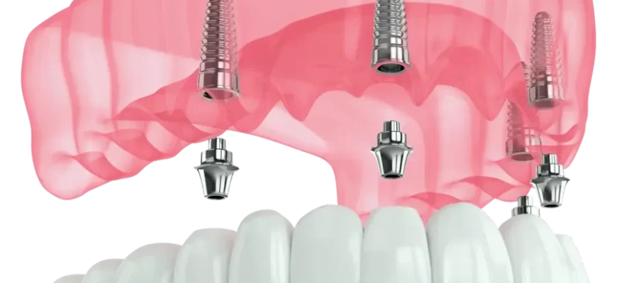 Імплант чи імплантат: як правильно обрати стоматологічний термін? Імплант чи імплантат: як правильно обрати стоматологічний термін?