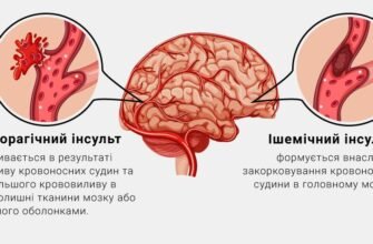 Інфаркт чи інсульт: що небезпечніше для життя та здоров’я?