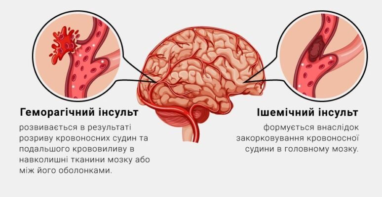 Інфаркт чи інсульт: що небезпечніше для життя та здоров’я?