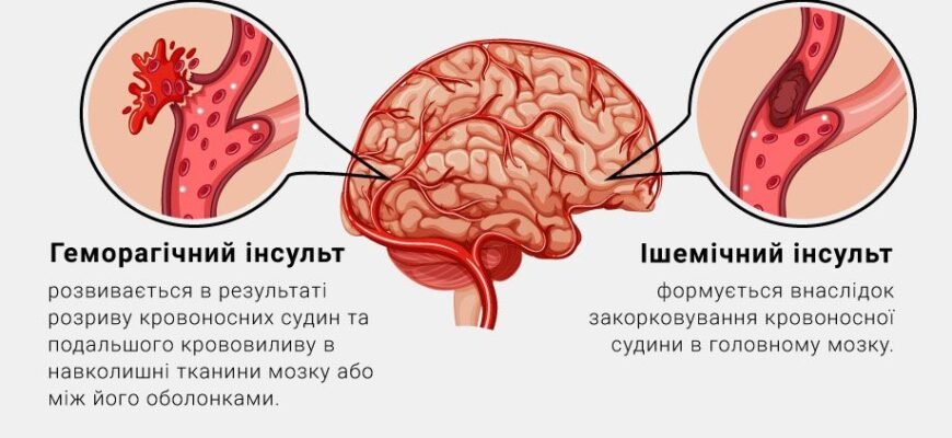Інфаркт чи інсульт: що небезпечніше для життя та здоров’я?