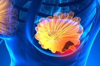 Лікування 4 стадії раку: можливості, методи та ефективність терапії