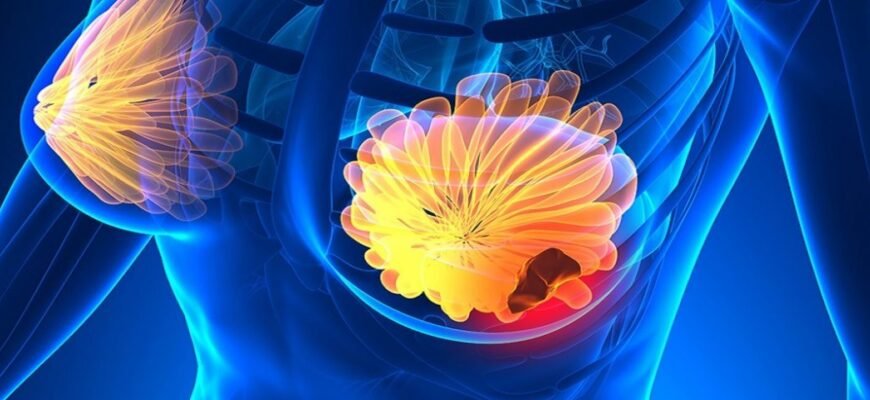 Лікування 4 стадії раку: можливості, методи та ефективність терапії