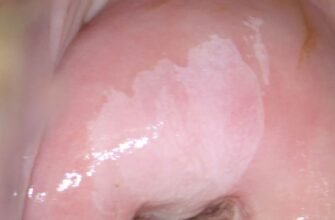 Може дисплазія виникати без ВПЛ: дослідження та факти для Google