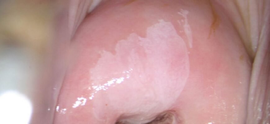 Може дисплазія виникати без ВПЛ: дослідження та факти для Google