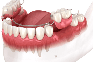 Цирконій vs. металокераміка: що обрати для ідеальних зубних протезів?
