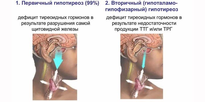 Ускладнення гіпотиреозу: як виникає кретинізм та його наслідки