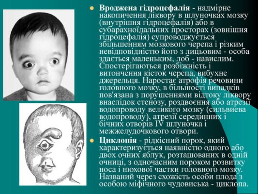 Вроджені вади розвитку: причини, види та сучасні методи лікування Вроджені вади розвитку: причини, види та сучасні методи лікування