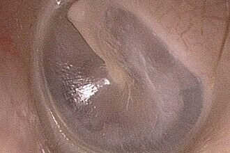 Як доглядати та захищати свою барабанну перетинку: поради та методи