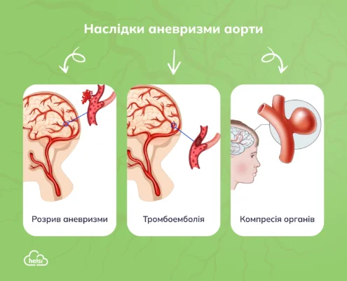 Аневризма: що це таке, причини появи та методи лікування Аневризма: що це таке, причини появи та методи лікування