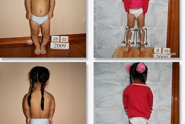 Все, що потрібно знати про ахондроплазію: причини, симптоми, лікування