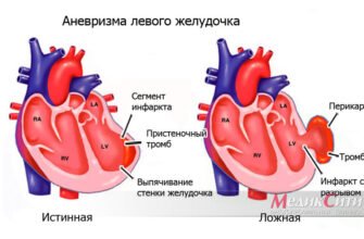 Аневризма серця: Що це таке і як впливає на ваше здоров’я?