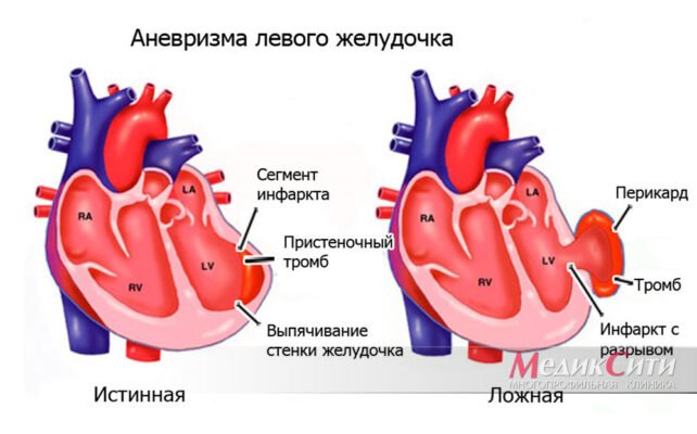 Аневризма серця: Що це таке і як впливає на ваше здоров’я?