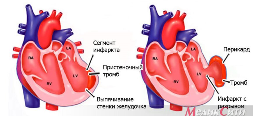 Аневризма серця: Що це таке і як впливає на ваше здоров’я?