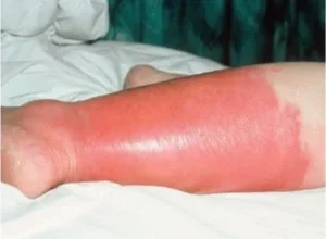 Бешиха: симптоми, причини, лікування та профілактичні заходи