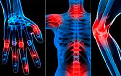 Деформуючий артроз: що це таке, причини, симптоми та лікування
