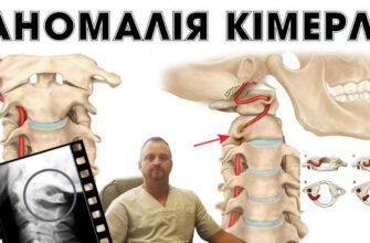 Екструзія хребта: що це таке і як її вчасно виявити?