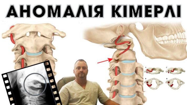 Екструзія хребта: що це таке і як її вчасно виявити? Екструзія хребта: що це таке і як її вчасно виявити?