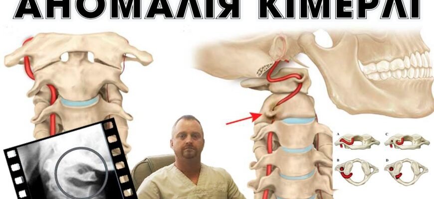 Екструзія хребта: що це таке і як її вчасно виявити?