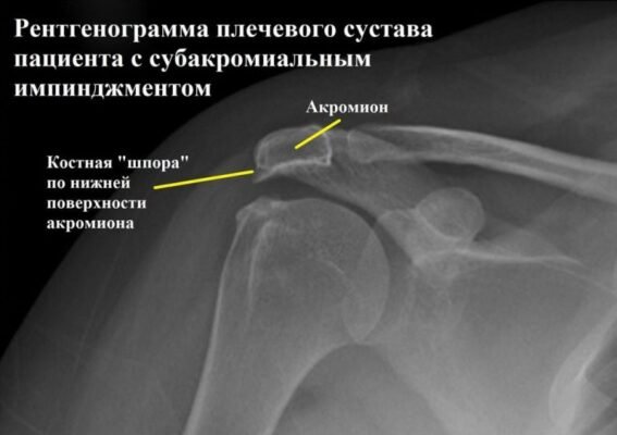 Імпіджмент синдром: що це таке, симптоми та лікування проблеми Імпіджмент синдром: що це таке, симптоми та лікування проблеми