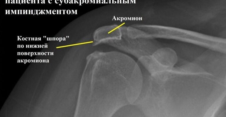 Імпіджмент синдром: що це таке, симптоми та лікування проблеми