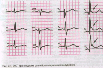 Лікування синдрому ранньої реполяризації шлуночків: сучасні підходи