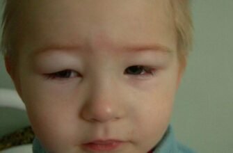 Ознаки нефротичного синдрому: як розпізнати та зрозуміти симптоми